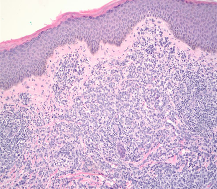 A microscopic image of a stained smear from a non-gynecological site.